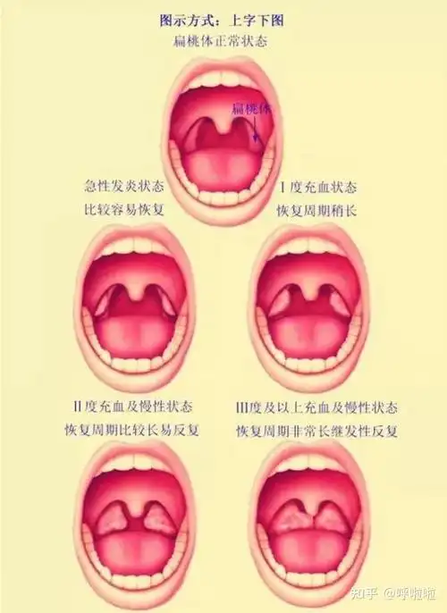 扁桃体本身结构就像一个马蜂窝,表面内陷形成隐窝,就像凹进去一个个洞