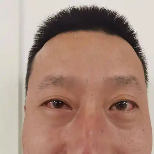 援助有期 帮扶无期|连二医专家助力陕西省澄城县医院开展斜视矫正术