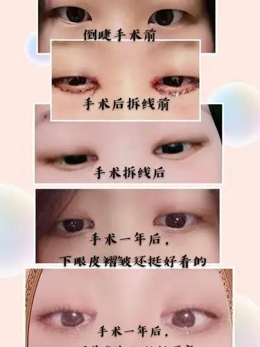 分享自己做倒睫手术的恢复过程,以及前后对比照,虽然_圈子-新氧美容
