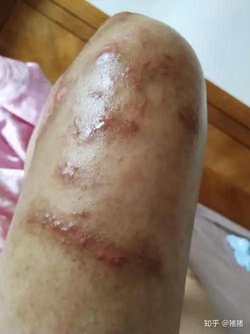 被海蜇蛰伤已经4个多月了这几天又复发了有经验的探讨一下怎么才能好