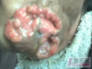 【原创】牙龈癌图片