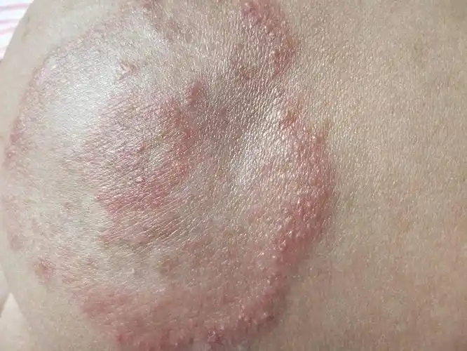 样子去医院检查是真菌感染涂了两天药感觉没什么效果而且感觉还多了