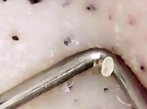 3,定期护理:每周定期使用清洁面膜或鼻贴,帮助快速改善肌肤黑头角栓