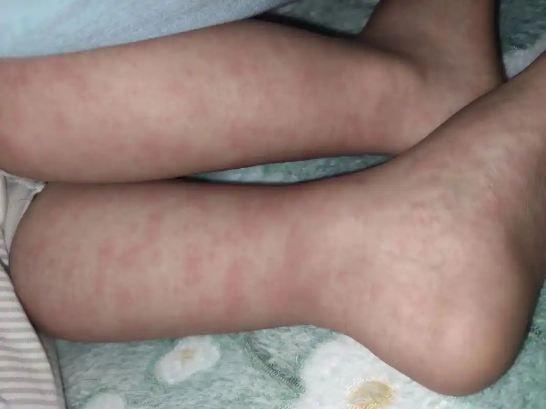 全身过敏起红疹  早上 - 抖音