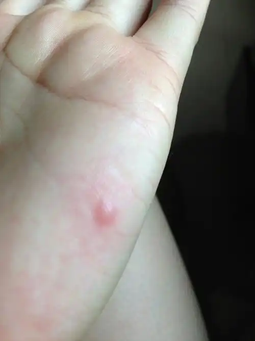 手上面只有一个包 不是很痒也不疼 像是蚊子  但我又害怕是蜱虫