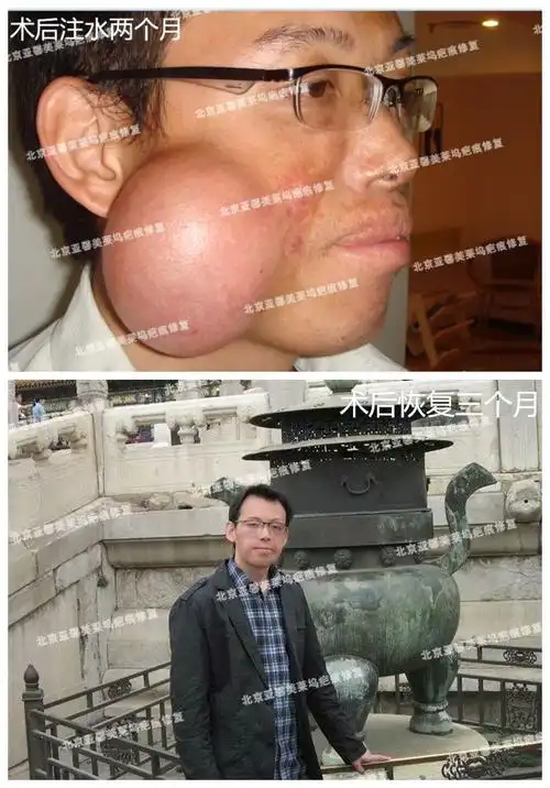 案例反馈扩张器去除面部27年烫伤疤痕