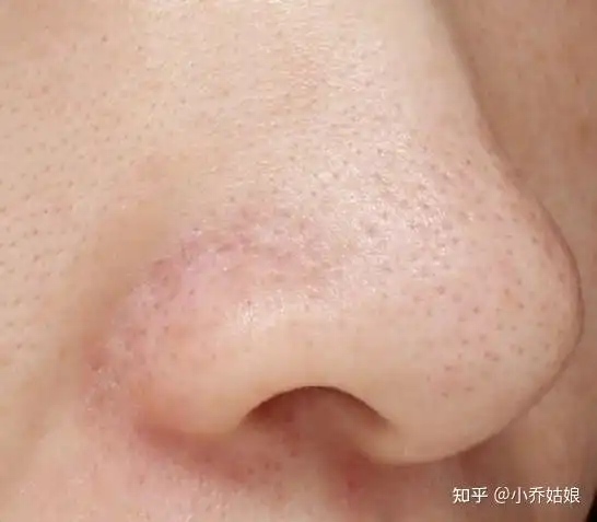 角栓型黑头表现形态补充一点,有些撕拉式面膜是胶状的,还有一些附着在