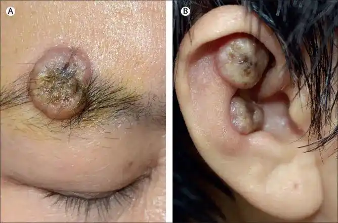 临床图片面部皮肤多发可消退的结节或为多发性角化棘皮瘤