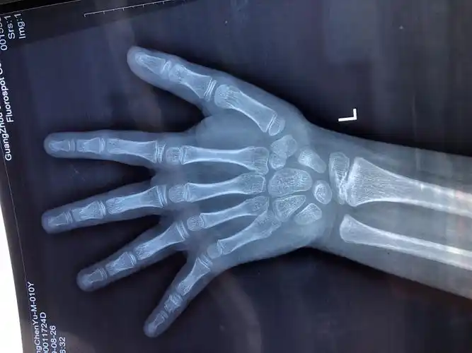 跪请那位医生帮看看孩子骨龄的片子可以吗?感谢