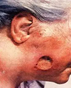 梅毒血清学试验阳性(图d,iii期梅毒疹,树胶肿).