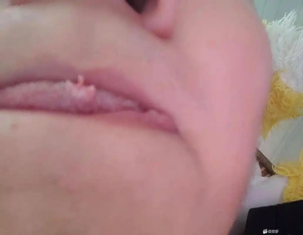 最近我舌头上长了个菜花一样的东西,有没有人知道这是啥啊