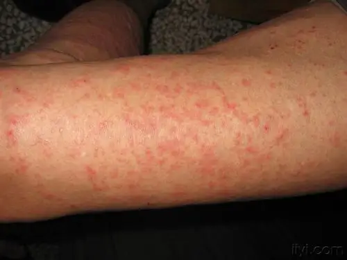 看图说话---老年瘙痒症继发湿疹样变?