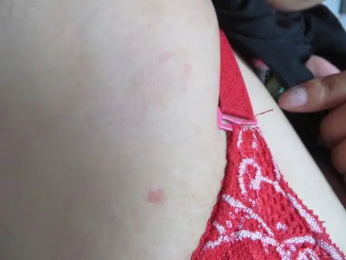 【请教】胸腹部皮疹1--2年,怎么办?