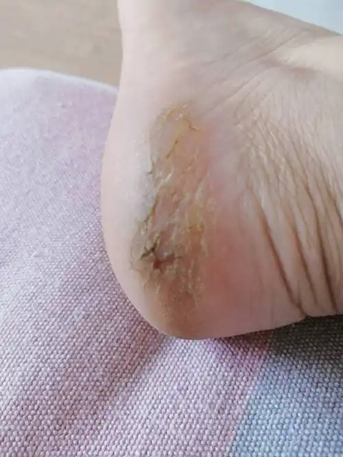 原创一到冬天脚后跟干裂起硬皮裂口子怎么办