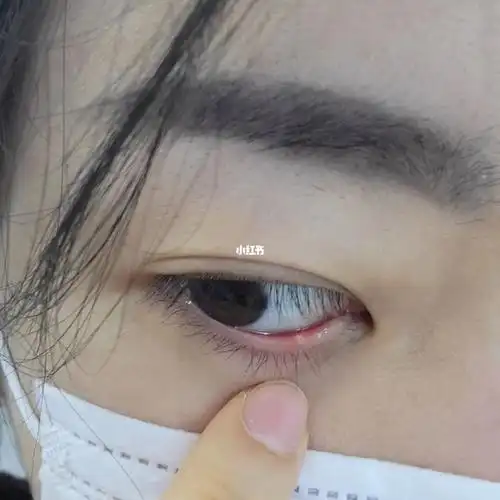 左滑看我的睑板腺堵塞