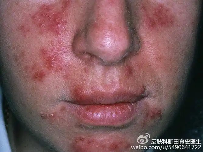 丘疹脓包型玫瑰痤疮,症状部位和粉刺,痤疮常发部位相似