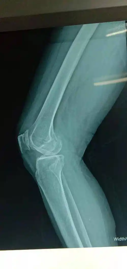 三院骨科积极创新,关节置换快速康复