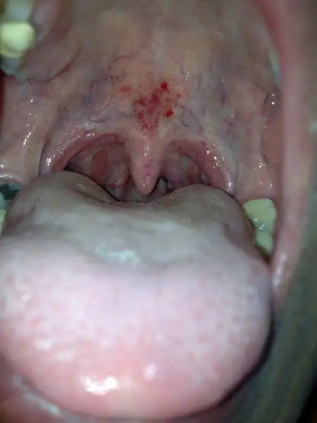 口腔上颚有红点