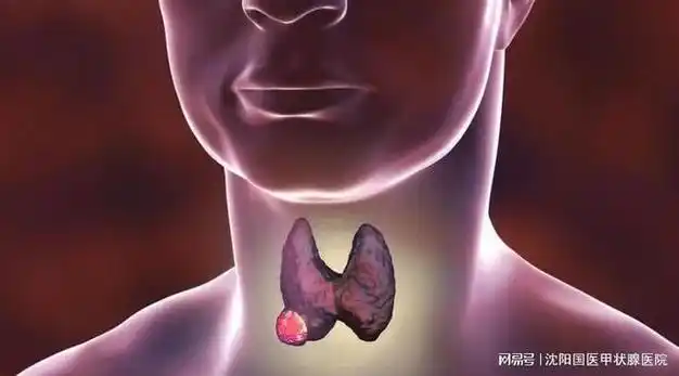 什么是桥本甲状腺炎不同阶段桥本氏病如何治疗消除桥本病根