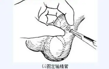 传说中的男性结扎手术全过程(附图), 做了真的会变成"太监"吗?