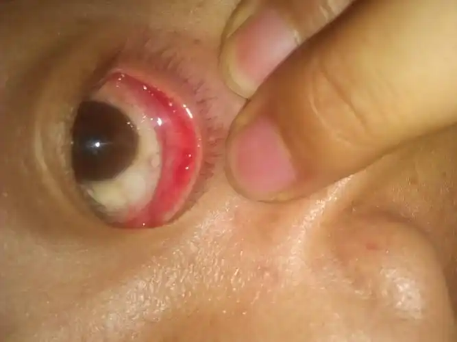 下眼睑里面有一排三个小泡泡求助各位前辈