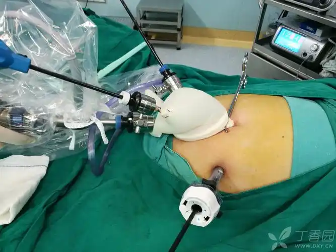 普通外科 肝胆胰脾/腔镜/介入比传统腹腔镜手术减少了2-4个戳孔,尤其