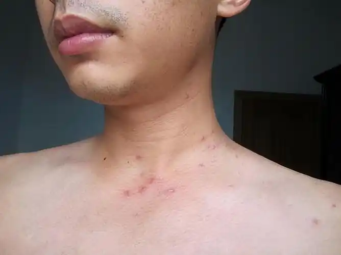 一般在经过一星期左右就能够愈合,但是对于艾滋病毒所引起的皮肤皮疹