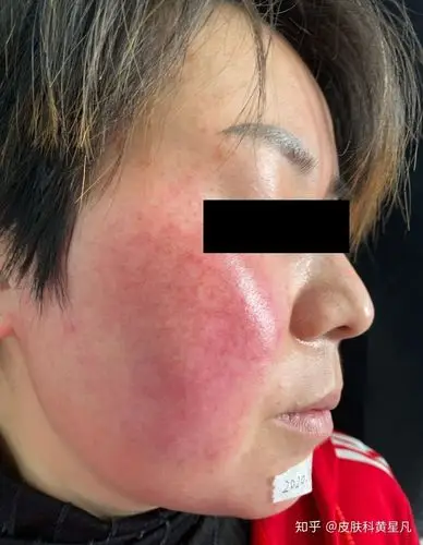 皮肤受损玫瑰痤疮