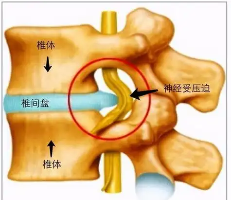 腰椎4一5节突出需要治疗吗