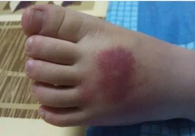 宝宝的脚 不知道被什么虫子咬了
