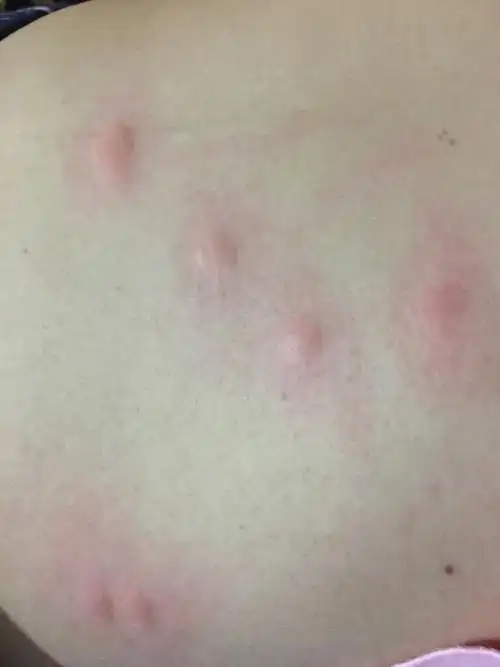 在草地被虫子咬了,不知道什么东西,怎么治疗