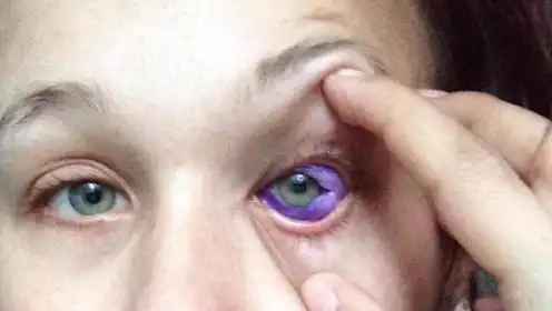 美女纹眼球纹身结果眼睛流出紫水,差点失明!