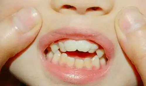 哺乳期宝宝吃奶时姿势很重要, 不信看看周冬雨嘴巴上的小秘密