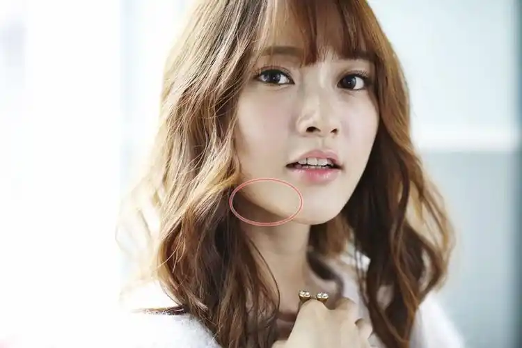 痘痘位置:腮帮子