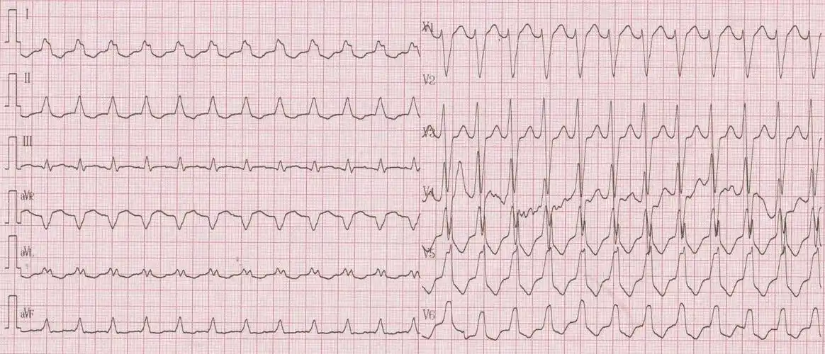 从一个真实病例,来看我们和室速的战斗|识"图"寻踪_室速_医脉通