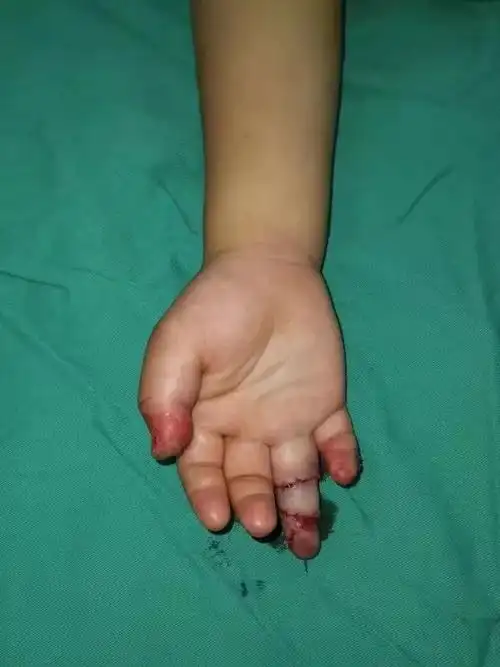 李守峰医师告诉小编:"当我看到挫伤这么严重的断指,我也没有十足的