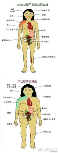 一幅图对比甲亢和甲减的临床表现