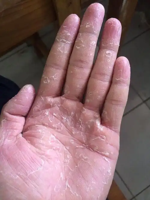 手癣的症状图片?_百度知道
