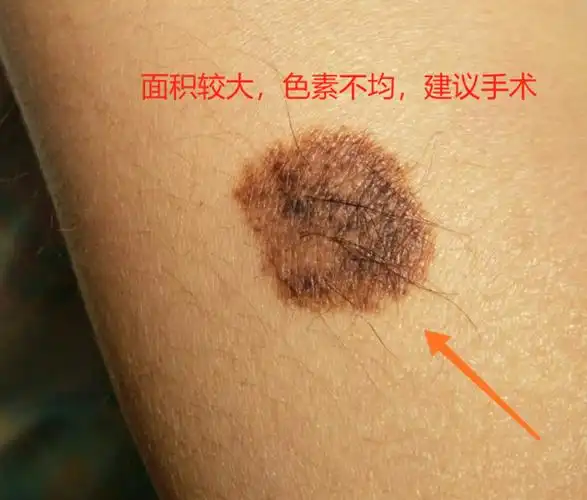 色素痣的鉴别与治疗