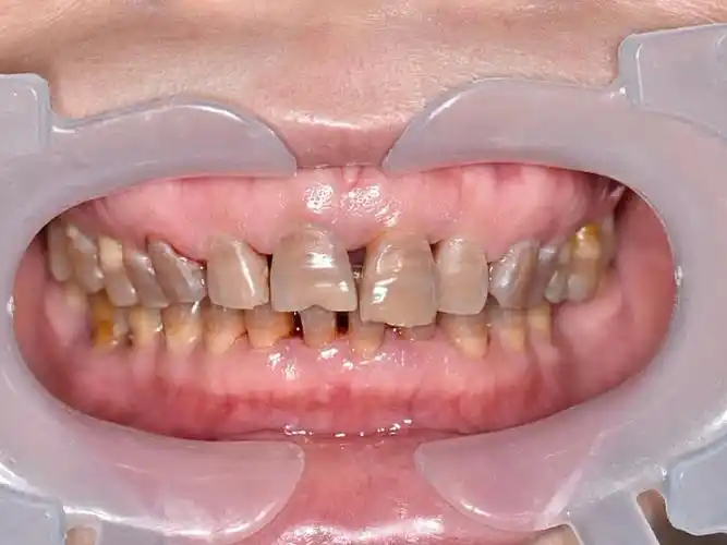 如何护理四环素牙齿?