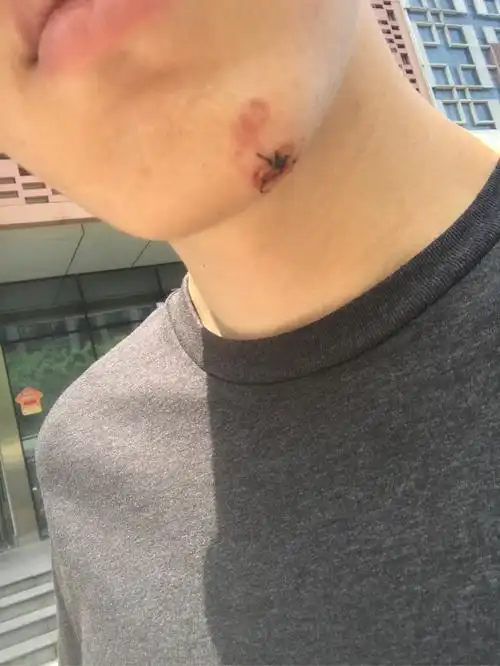 摔了下巴缝了好几针紧急去医院缝了以后会留疤吗我还年轻是个女孩不想