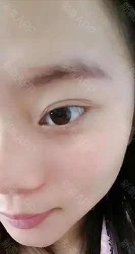 水光针7天后,脸上皮肤比之前好了很多,以后要按照疗_圈子-新氧美容