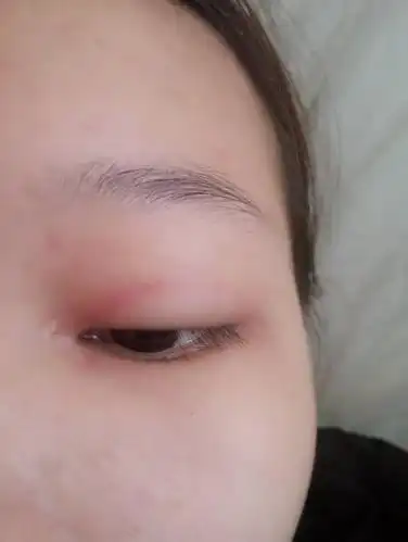 开内眼角伤口上冒出一个小白点,摸着有点凸,不知道是不脂肪粒?(好