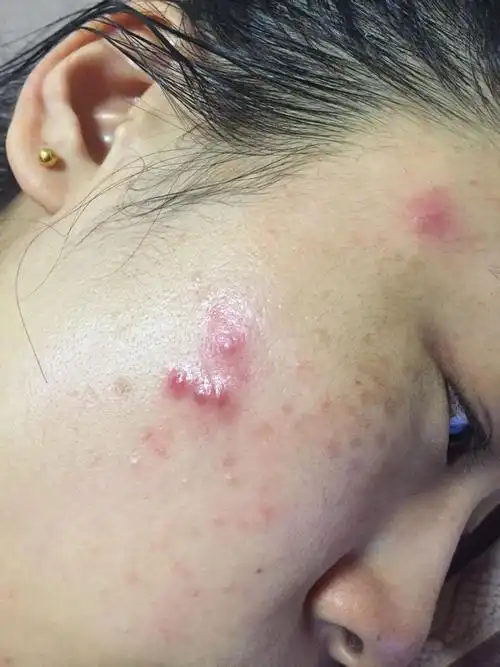 脸上长痘痘怎么能快速治疗好,之前没有,就是有点斑,用醋对白术洗完