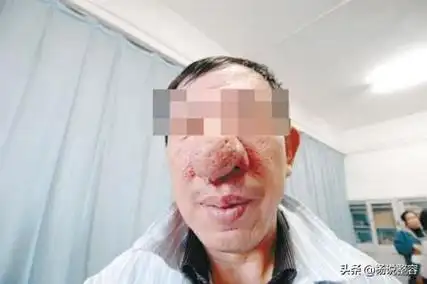 什么叫酒糟鼻(科普什么是酒渣鼻不看不知道) - 桓桂百科号