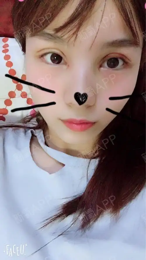 【米尚恩park修复双眼皮加开眼角第十天】