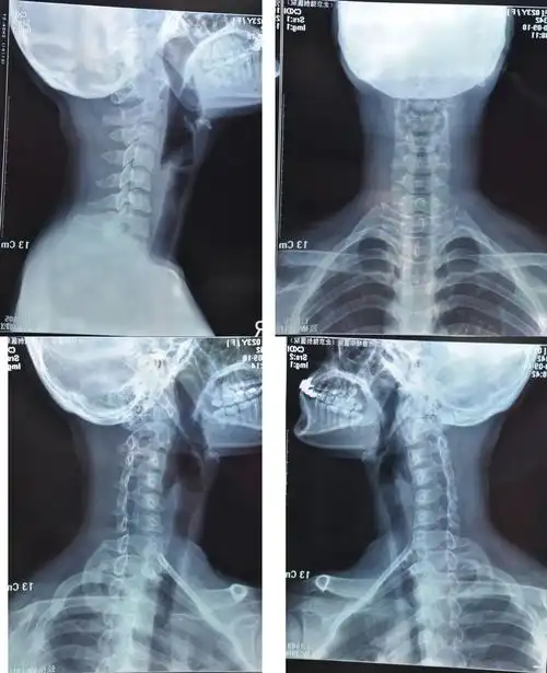 颈椎曲度反向… 很难受 急~~ 附图 (我想问一下我这是曲度反向,看上去