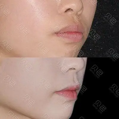 来分享一下凸嘴女孩的牙齿矫正前后效果,庆幸自己的选择