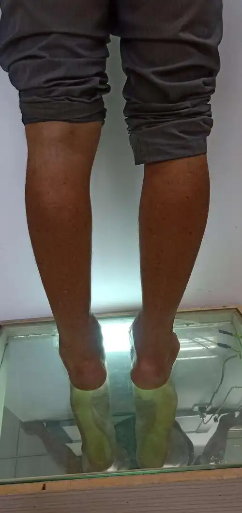 踝关节外伤后畸形