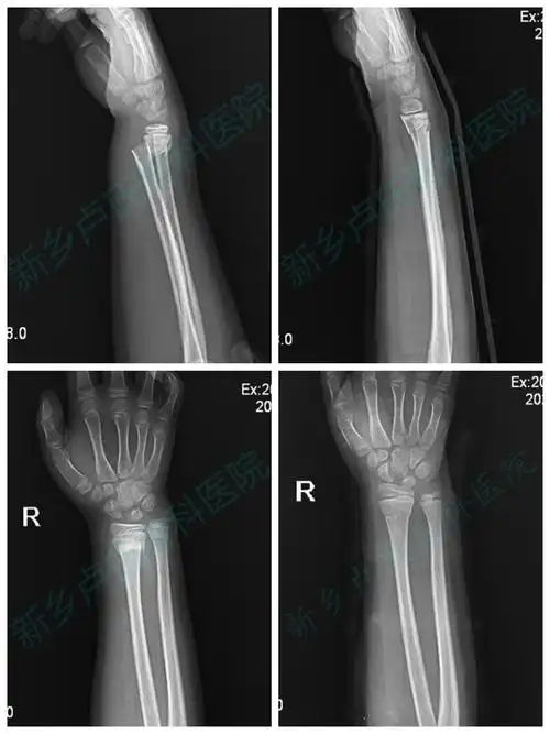儿童尺桡骨远端骨折